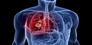 lung cancer Mesothelioma